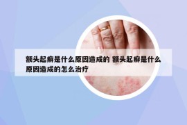 額頭起癬是什么原因造成的 額頭起癬是什么原因造成的怎么治療