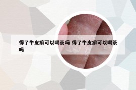 得了牛皮癬可以喝茶嗎 得了牛皮癬可以喝茶嗎