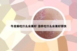 牛皮癬吃什么水果好 濕疹吃什么水果好得快