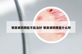 銀屑病初期能不能治好 銀屑病初期是什么樣