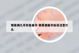 銀屑病幾月份能備孕 銀屑病備孕應(yīng)該注意什么