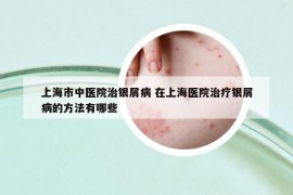 上海市中醫(yī)院治銀屑病 在上海醫(yī)院治療銀屑病的方法有哪些