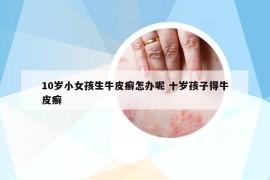 10歲小女孩生牛皮癬怎辦呢 十歲孩子得牛皮癬