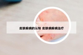 皮膚癬病的認知 皮膚病癬病治療