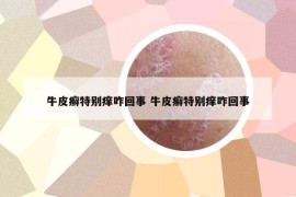 牛皮癬特別癢咋回事 牛皮癬特別癢咋回事