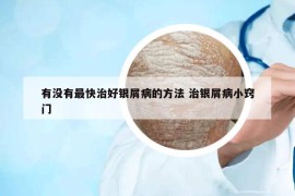 有沒有最快治好銀屑病的方法 治銀屑病小竅門