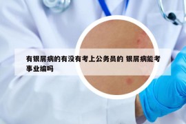 有銀屑病的有沒有考上公務(wù)員的 銀屑病能考事業(yè)編嗎