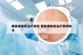 銀屑病免疫治療貴嗎 銀屑病免疫治療貴嗎知乎