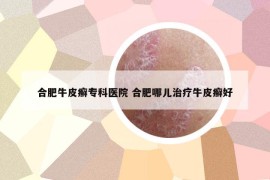 合肥牛皮癬?？漆t(yī)院 合肥哪兒治療牛皮癬好