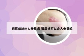 銀屑病能吃人參果嗎 銀屑病可以吃人參果嗎