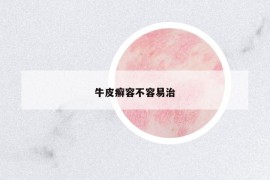 牛皮癬容不容易治