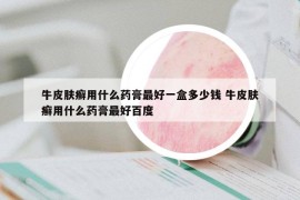 牛皮膚癬用什么藥膏最好一盒多少錢 牛皮膚癬用什么藥膏最好百度