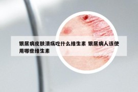 銀屑病皮膚潰瘍吃什么維生素 銀屑病人該使用哪些維生素