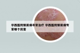 華西醫(yī)院銀屑病尋常治療 華西醫(yī)院銀屑病專(zhuān)家哪個(gè)厲害