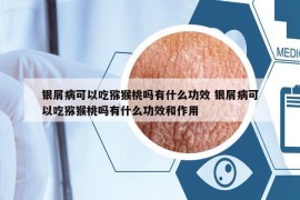 銀屑病可以吃獼猴桃嗎有什么功效 銀屑病可以吃獼猴桃嗎有什么功效和作用
