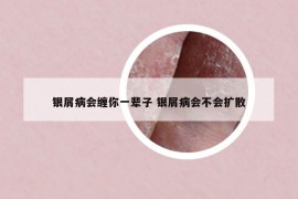 銀屑病會(huì)纏你一輩子 銀屑病會(huì)不會(huì)擴(kuò)散