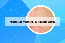 銀屑病小腿嚴重能治好么 小腿銀屑病疼痛