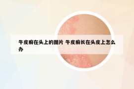 牛皮癬在頭上的圖片 牛皮癬長(zhǎng)在頭皮上怎么辦