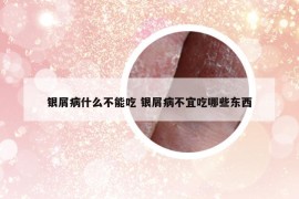 銀屑病什么不能吃 銀屑病不宜吃哪些東西