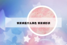 銀屑病是什么顏色 銀屑病形狀