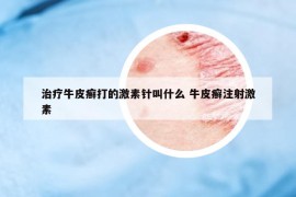 治療牛皮癬打的激素針叫什么 牛皮癬注射激素