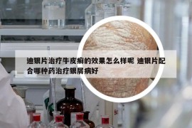 迪銀片治療牛皮癬的效果怎么樣呢 迪銀片配合哪種藥治療銀屑病好