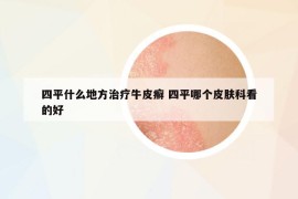 四平什么地方治療牛皮癬 四平哪個(gè)皮膚科看的好