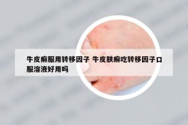 牛皮癬服用轉(zhuǎn)移因子 牛皮膚癬吃轉(zhuǎn)移因子口服溶液好用嗎