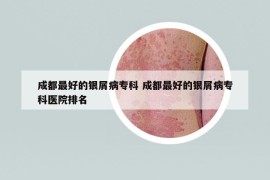 成都最好的銀屑病專科 成都最好的銀屑病?？漆t(yī)院排名