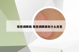 銀屑病眼睛 銀屑病眼睛有什么危害