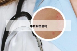 牛皮癬怕醋嗎