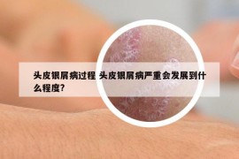 頭皮銀屑病過程 頭皮銀屑病嚴重會發(fā)展到什么程度?