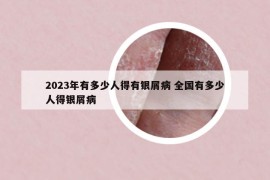 2023年有多少人得有銀屑病 全國(guó)有多少人得銀屑病