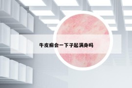 牛皮癬會一下子起滿身嗎