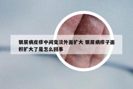 銀屑病皮疹中間變淡外面擴大 銀屑病疹子面積擴大了是怎么回事