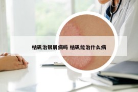 枯礬治銀屑病嗎 枯礬能治什么病
