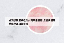 點滴狀銀屑病吃什么藥效果最好 點滴狀銀屑病吃什么藥好得快