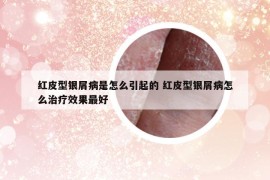 紅皮型銀屑病是怎么引起的 紅皮型銀屑病怎么治療效果最好