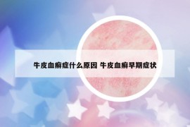 牛皮血癬癥什么原因 牛皮血癬早期癥狀