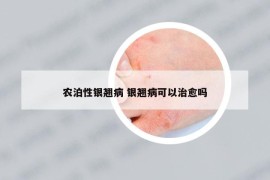 農(nóng)泊性銀翹病 銀翹病可以治愈嗎