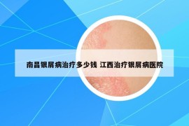 南昌銀屑病治療多少錢 江西治療銀屑病醫(yī)院