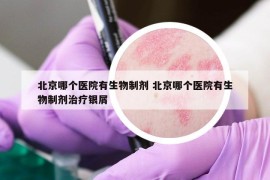 北京哪個醫(yī)院有生物制劑 北京哪個醫(yī)院有生物制劑治療銀屑