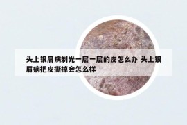 頭上銀屑病剃光一層一層的皮怎么辦 頭上銀屑病把皮撕掉會(huì)怎么樣