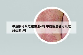 牛皮癬可以吃維生素e嗎 牛皮癬患者可以吃維生素c嗎