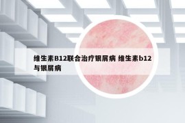 維生素B12聯(lián)合治療銀屑病 維生素b12與銀屑病
