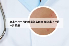 腿上一片一片的癬是怎么回事 腿上出了一片一片的癬