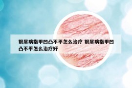 銀屑病指甲凹凸不平怎么治療 銀屑病指甲凹凸不平怎么治療好