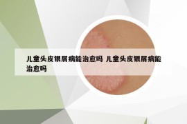 兒童頭皮銀屑病能治愈嗎 兒童頭皮銀屑病能治愈嗎