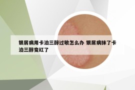 銀屑病用卡泊三醇過敏怎么辦 銀屑病抹了卡泊三醇變紅了