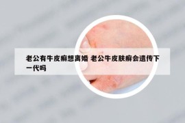 老公有牛皮癬想離婚 老公牛皮膚癬會(huì)遺傳下一代嗎